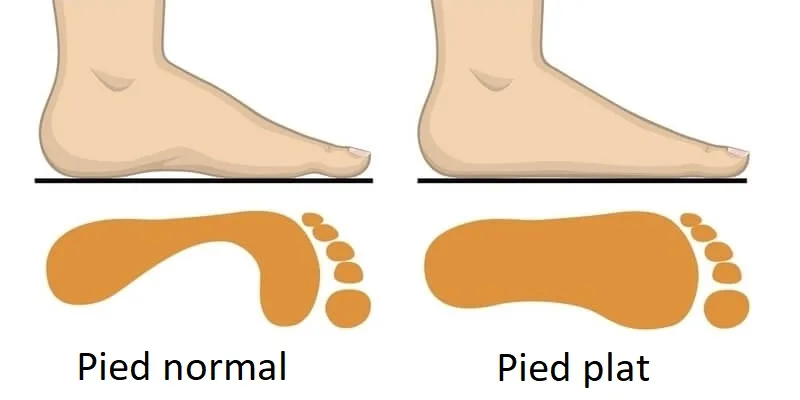 Image présentant un pied-plat et un pied normal avec leurs empreintes respectives